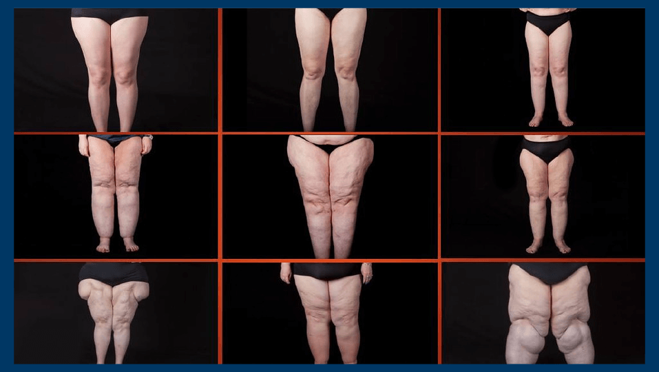 Cirugía de lipedema: muslos y fotos del progreso 