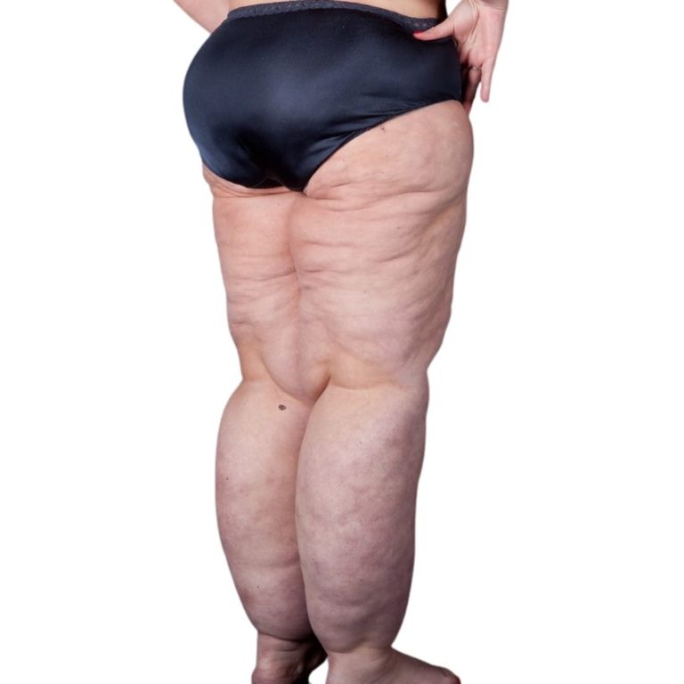 LIPEDEMA_WEB_8