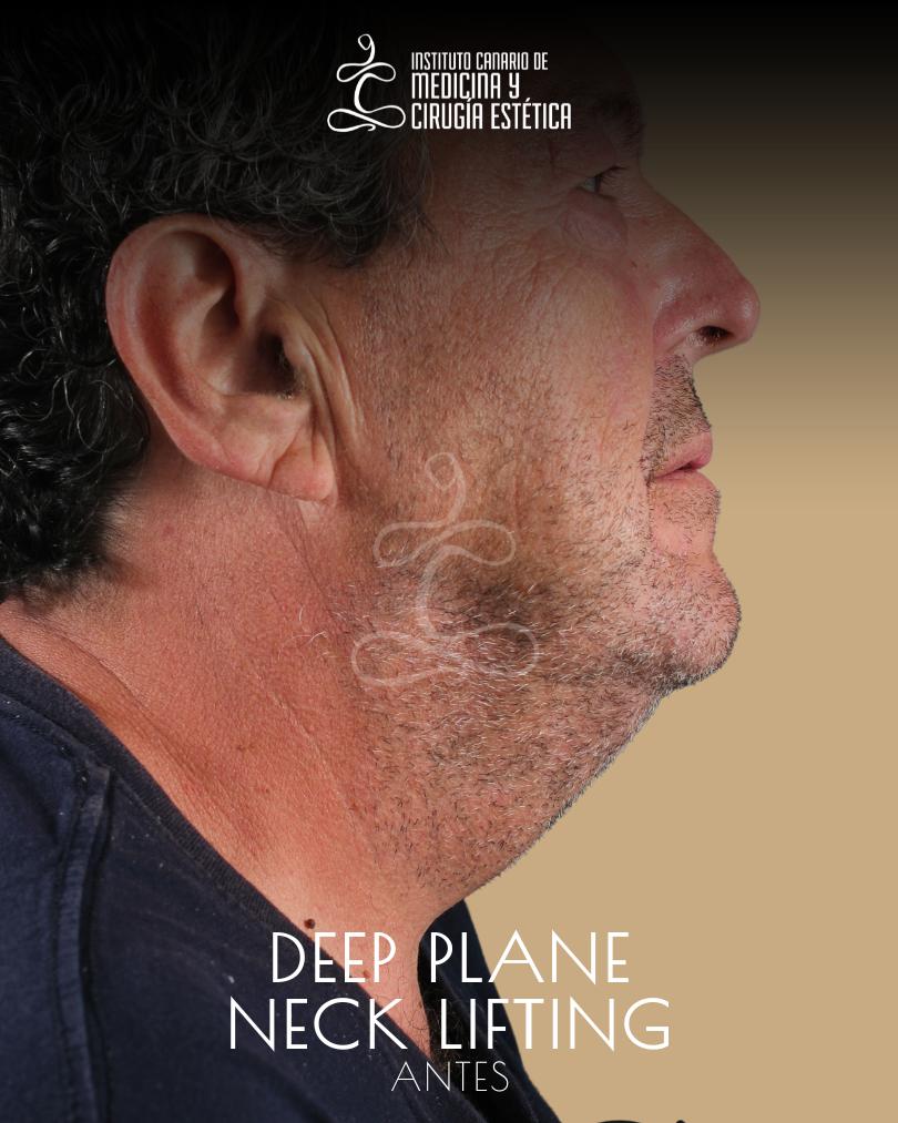 DEEP_PLANE_LIFTING_FACIAL_GRAN_CANARIA_ICMCE_DR_DANIEL_RODRIGUEZ_MORALES_DE_LOS_RIOS_1