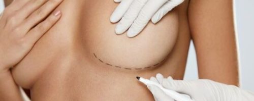 Reducción de mamas ICMCE_peq